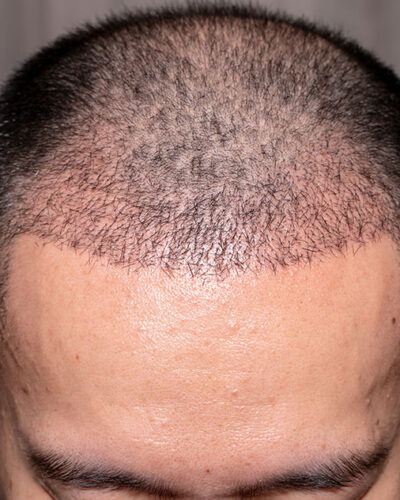 hair-transplant-edt-2